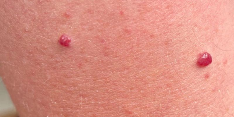 Chọn số may mắn từ nốt ruồi son