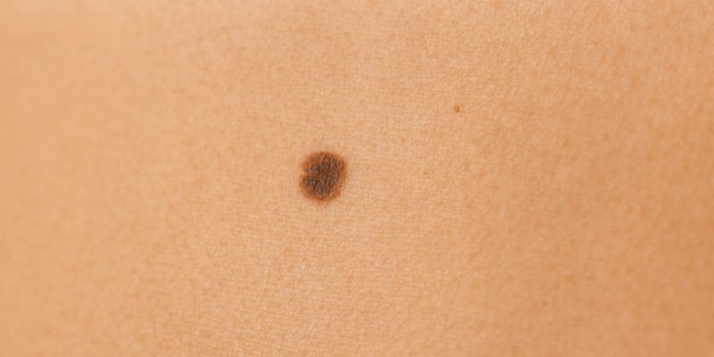 Hiểu đúng về nốt ruồi phong thủy và vận mệnh