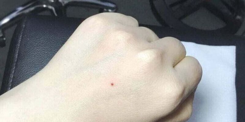 Nốt ruồi son và vận mệnh may mắn